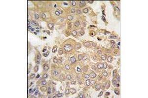Formalin-fixed and paraffin-embedded human lung carcinoma tissue reacted with MAPK4 antibody (N-term), which was peroxidase-conjugated to the secondary antibody, followed by DAB staining. (MAPK4 antibody  (N-Term))