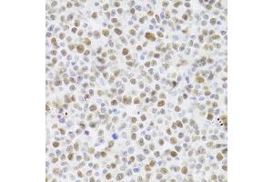 Immunohistochemistry of paraffin-embedded human B cell lymphoma using TP53 Antibody (ABIN5971632) at dilution of 1/100 (40x lens).