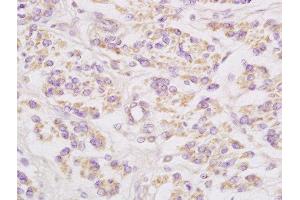 Formalin-fixed and paraffin embedded human cervical carcinoma labeled with Anti-Connexin-32 Polyclonal Antibody, Unconjugated  at 1:200 followed by conjugation to the secondary antibody and DAB staining (GJB1 antibody  (AA 201-283))