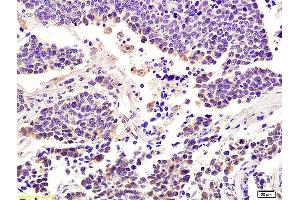 Formalin-fixed and paraffin embedded human lung carcinoma labeled with Anti-Integrin alpha 7/ITGA7 Polyclonal Antibody, Unconjugated (ABIN734858) at 1:200 followed by conjugation to the secondary antibody and DAB staining.