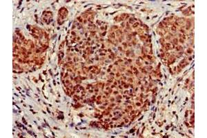 Immunohistochemistry of paraffin-embedded human ovarian cancer using ABIN7170803 at dilution of 1:100 (STOML3 antibody  (AA 205-291))