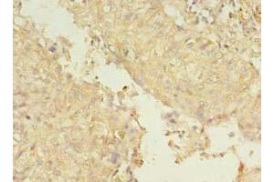 Immunohistochemistry of paraffin-embedded human lung cancer using ABIN7151226 at dilution of 1:100 (SMURF2 antibody  (AA 1-748))