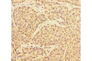 Immunohistochemistry of paraffin-embedded human ovarian cancer using ABIN7174174 at dilution of 1:100 (PRPF4 antibody  (AA 1-260))