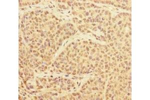 Immunohistochemistry of paraffin-embedded human ovarian cancer using ABIN7174174 at dilution of 1:100 (PRPF4 antibody  (AA 1-260))