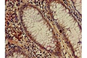 Immunohistochemistry of paraffin-embedded human colon cancer using ABIN7155043 at dilution of 1:100 (c-MET antibody  (AA 83-209))