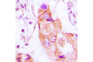 Immunohistochemical analysis of AIM2 staining in human lung cancer formalin fixed paraffin embedded tissue section. (AIM2 antibody  (Center))