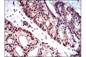 Immunohistochemical analysis of paraffin-embedded colon cancer tissues using WHSC2 mouse mAb with DAB staining. (WHSC2 antibody  (AA 280-511))