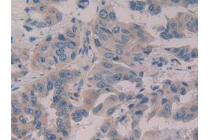 DAB staining on IHC-P; Samples: Human Breast cancer Tissue (WISP1 antibody  (AA 216-347))