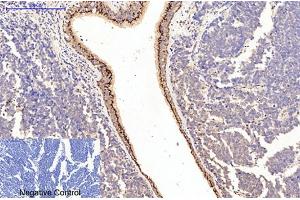 Immunohistochemical analysis of paraffin-embedded human lung cancer tissue. (Collagen Type I antibody)