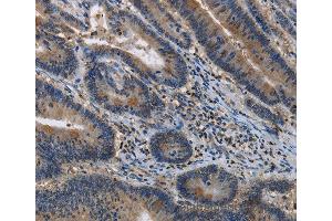 Immunohistochemistry of Human colon cancer using ITPR2 Polyclonal Antibody at dilution of 1:40