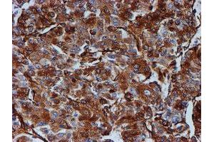 Immunohistochemical staining of paraffin-embedded Carcinoma of Human liver tissue using anti-TUBB4 mouse monoclonal antibody.