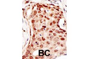 Formalin-fixed and paraffin-embedded human cancer tissue reacted with CBLC polyclonal antibody  , which was peroxidase-conjugated to the secondary antibody, followed by DAB staining.