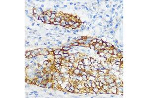 Immunohistochemistry of paraffin-embedded human esophageal cancer using Collagen XVII/COL17 Rabbit mAb (ABIN7266467) at dilution of 1:100 (40x lens). (COL17A1 antibody)