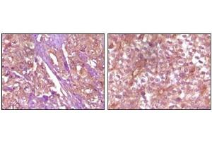 Immunohistochemical analysis of paraffin-embedded Human pancreas carcinoma (left) and breast carcinoma (right) tissue, showing membrane and cytoplasmic (pancreas carcinoma) localization, membrane (breast carcinoma) localization using EphB4 antibody with DAB staining. (EPH Receptor B4 antibody)