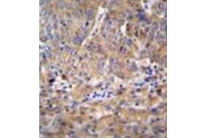 Formalin fixed and paraffin embedded human hepatocarcinoma reacted with DEF Antibody (N-term) followed by peroxidase conjugation of the secondary antibody and DAB staining (C11ORF58 antibody  (N-Term))