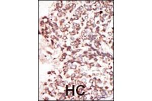 Formalin-fixed and paraffin-embedded human cancer tissue reacted with the primary antibody, which was peroxidase-conjugated to the secondary antibody, followed by DAB staining. (PIM2 antibody  (C-Term))