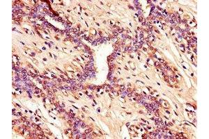 Immunohistochemistry of paraffin-embedded human breast cancer using  at dilution of 1:100 (CDKN2A antibody  (AA 1-86))