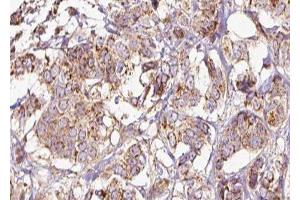 ABIN6275243 at 1/100 staining Human breast cancer tissue by IHC-P.