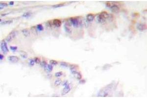 Immunohistochemistry (IHC) analyzes of CREB-1 antibody in paraffin-embedded human lung carcinoma tissue. (CREB1 antibody)