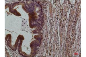 Immunohistochemistry (IHC) analysis of paraffin-embedded Human Colon Carcinoma using STAT3 Mouse Monoclonal Antibody diluted at 1:200. (STAT3 antibody)