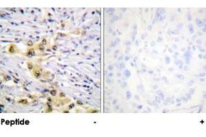 Immunohistochemical analysis of paraffin-embedded human lung carcinoma tissue using IGF2R polyclonal antibody . (IGF2R antibody)