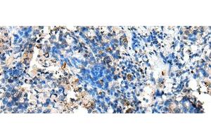 Immunohistochemistry of paraffin-embedded Human lung cancer tissue using NUDT10 Polyclonal Antibody at dilution of 1:70(x200) (NUDT10 antibody)