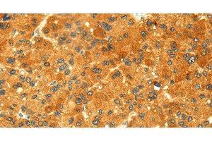 Immunohistochemistry of paraffin-embedded Human liver cancer tissue using GK1 Polyclonal Antibody at dilution 1:60 (Glycerol Kinase antibody)