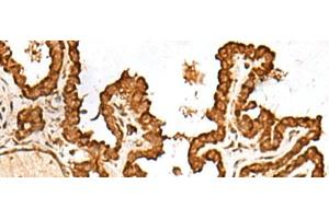 Immunohistochemistry of paraffin-embedded Human thyroid cancer tissue using FAM200A Polyclonal Antibody at dilution of 1:55(x200) (FAM200A antibody)