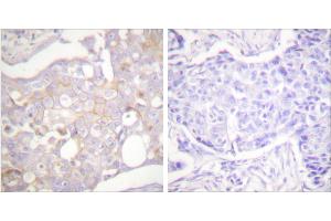 Peptide - +Immunohistochemical analysis of paraffin-embedded human breast carcinoma tissue using Claudin 4 antibody (#C0141). (Claudin 4 antibody)
