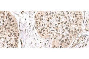 Immunohistochemistry of paraffin-embedded Human esophagus cancer tissue using ERH Polyclonal Antibody at dilution of 1:55(x200)