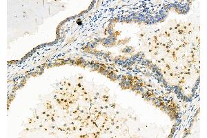 ABIN6257891 and ABIN6273815 at 1/100 staining Human prostate cancer by IHC-P. (TRIO antibody  (Internal Region))
