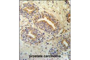 CWC15 Antibody IHC analysis in formalin fixed and paraffin embedded prostate carcinoma followed by peroxidase conjugation of the secondary antibody and DAB staining. (CWC15 antibody  (AA 123-152))