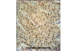 WDR32 antibody (N-term) (ABIN654593 and ABIN2844292) immunohistochemistry analysis in formalin fixed and paraffin embedded human hepatocarcinoma followed by peroxidase conjugation of the secondary antibody and DAB staining.