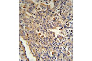 GLA Antibody (N-term) (ABIN390687 and ABIN2840977) IHC analysis in formalin fixed and paraffin embedded human Lung carcinoma followed by peroxidase conjugation of the secondary antibody and DAB staining. (GLA antibody  (N-Term))