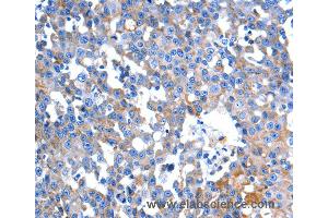 Immunohistochemistry of Human colon cancer using HINT2 Polyclonal Antibody at dilution of 1:60