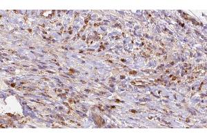 ABIN6272697 at 1/100 staining Human liver cancer tissue by IHC-P. (GRM2 antibody  (Internal Region))