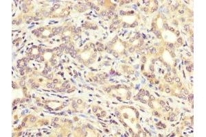 IHC image of ABIN7144603 diluted at 1:200 and staining in paraffin-embedded human liver cancer performed on a Leica BondTM system. (ATE1 antibody  (AA 105-253))