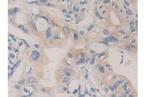 DAB staining on IHC-P; Samples: Human Bile duct cancer Tissue (CPB1 antibody  (AA 111-417))