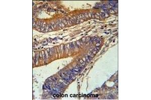 KLC3 Antibody (Center) (ABIN651542 and ABIN2840291) immunohistochemistry analysis in formalin fixed and paraffin embedded human colon carcinoma followed by peroxidase conjugation of the secondary antibody and DAB staining. (KLC3 antibody  (AA 245-274))