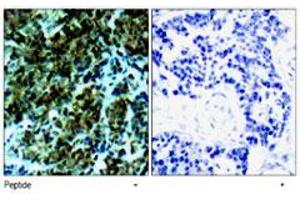 Immunohistochemical analysis of paraffin-embedded human breast carcinoma tissue, using Ctdp1 polyclonal antibody . (CTDP1 antibody  (N-Term))