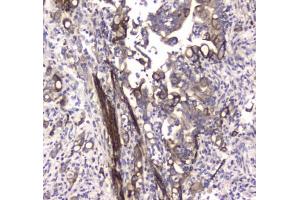 IHC testing of FFPE human colon cancer tissue with LC3A antibody at 1ug/ml.