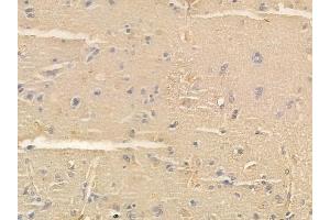 ABIN6261890 and ABIN6266971 at 1/100 staining human glioblastoma by IHC-P.