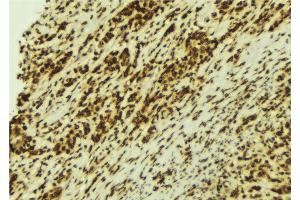 ABIN6274154 at 1/100 staining Human breast cancer tissue by IHC-P. (HNRNPC antibody  (C-Term))