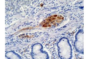 Immunohistochemistry staining of colon carcinoma (paraffin-embedded sections) with anti-p21 (WA-1). (p21 antibody)