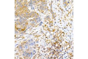 Immunohistochemistry of paraffin-embedded human esophageal cancer using CLIC4 Rabbit pAb (ABIN6127638, ABIN6138723, ABIN6138724 and ABIN6222890) at dilution of 1:50 (40x lens). (CLIC4 antibody  (AA 1-253))