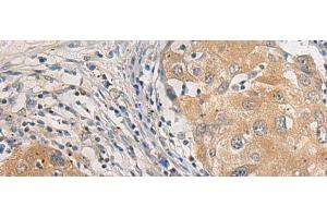 Immunohistochemistry of paraffin-embedded Human breast cancer tissue using AGAP3 Polyclonal Antibody at dilution of 1:25(x200)
