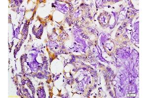 Formalin-fixed and paraffin embedded human colon carcinoma labeled with Rabbit Anti-MMP-7 Polyclonal Antibody, Unconjugated at 1:200 followed by conjugation to the secondary antibody and DAB staining. (MMP7 antibody  (AA 151-250))