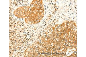 Immunohistochemistry of Human colon cancer using RARRES1 Polyclonal Antibody at dilution of 1:60