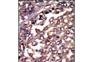 Formalin-fixed and paraffin-embedded human cancer tissue reacted with the primary antibody, which was peroxidase-conjugated to the secondary antibody, followed by AEC staining. (PRKACA antibody  (N-Term, Regulatory Subunit 1))