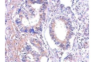 IHC-P Image Immunohistochemical analysis of paraffin-embedded human gastric cancer, using P2Y7, antibody at 1:500 dilution. (Leukotriene B4 Receptor/BLT antibody)